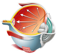 Diagram illustrating pressures exerted by glaucoma