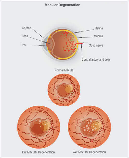 Macular Degeneration