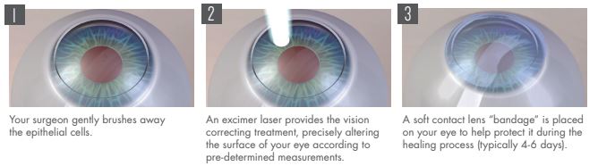 Illustrated Diagram of PRK Steps