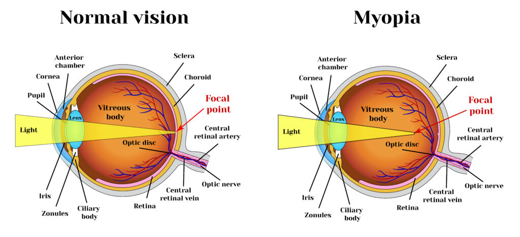 lefordítani a látást myopia következik be